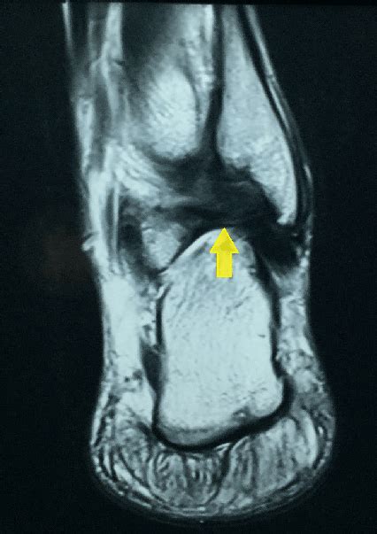 Arrow showing healed posterior syndesmotic ligament. | Download Scientific Diagram