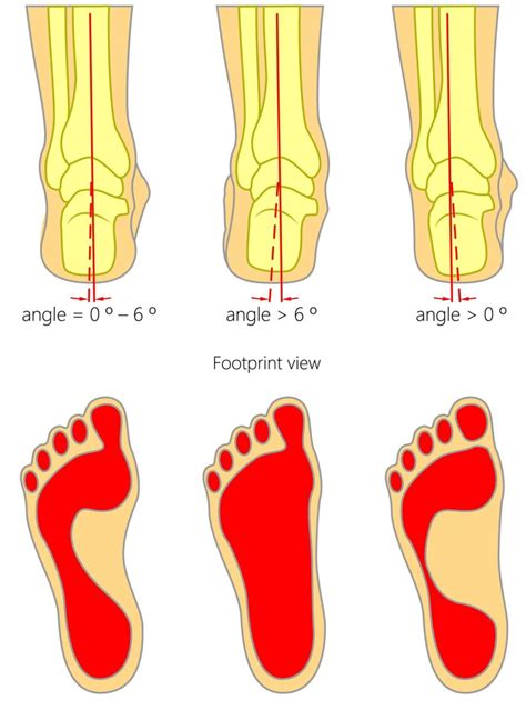 Bone On Inside Of Foot Sticks Out And Hurts Online Emergencydentistry