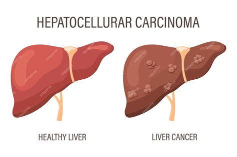 Carcinome Hépatocellulaire Maladies Du Foie Foie En Bonne Santé Et Cancer Du Foie Banner D