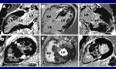 Contrast Enhanced Cmr Images In 6 Different Hcm Patients Demonstrating Download Scientific