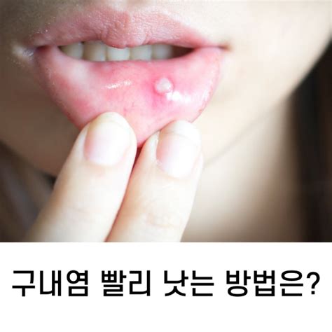 구내염 빨리 낫는 방법 이렇게 해결해 보세요 네이버 블로그