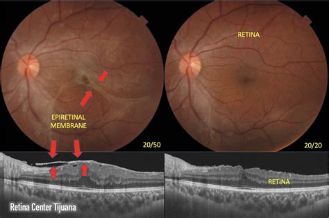 Epiretinal membrane treatment - Retina Center Tijuana