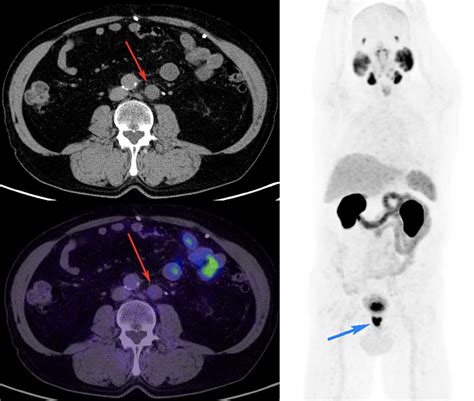 ⁶⁸Ga PSMA PET CT performed for primary staging of Gleason score 4 3