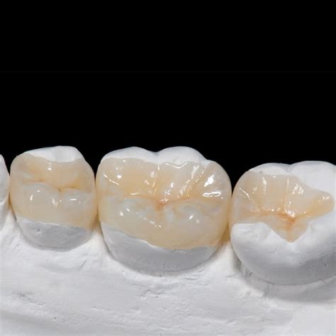 Denture Manufature All Ceramic Restorations Ips E Max Inlay Onlay