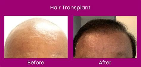 Best Hair Transplant In Ahmedabad Affordable Hair Transplant Cost In