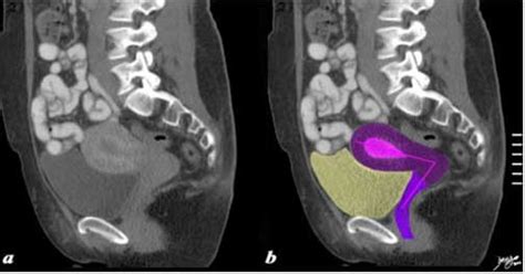 Uterus Anatomy Mri