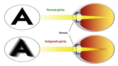 Astigmat Nedir ve Neden Olur Belirtileri ve Tedavi Yöntemleri Nelerdir