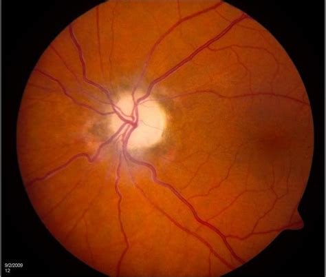 Optic Nerve Disease Eye Specialist Treatments Types And Symptoms