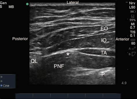 Unanticipated Motor Weakness With Ultrasound Guided Transversalis Fascia Plane Block Semantic