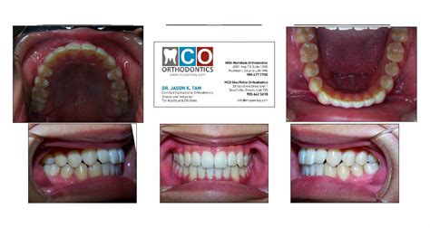 Your Markham Orthodontist Toronto Invisalign And Richmond Hill Braces