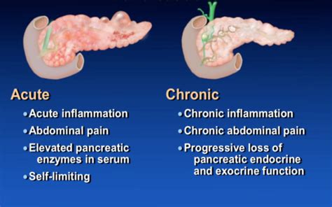 1 30 Pancreatitis Flashcards Quizlet