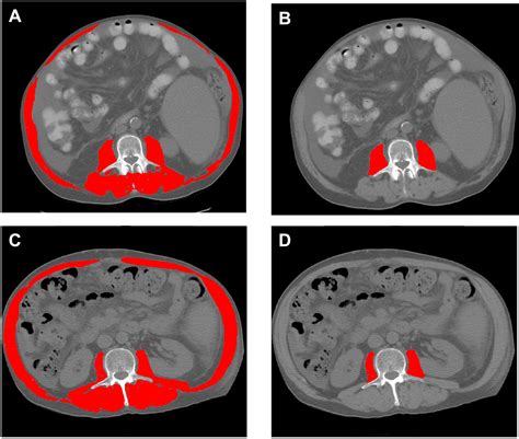 Poor Performance Of Psoas Muscle Index For Identification Of Patients