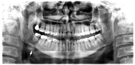 Sialoliths Of Submandibular Gland And Whartons Duct Orthopantomography