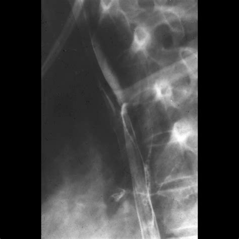 Esophageal Atresia Pediatric Radiology Reference Article Pediatric