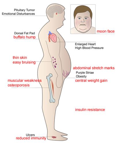 CNM09 36 CUSHING SYNDROME DISEASE Cartes Quizlet