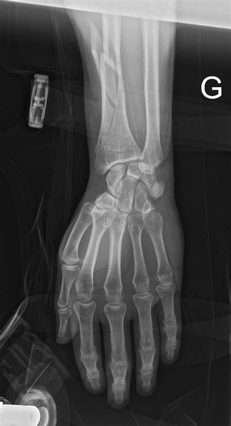 Galeazzi Fracture : r/Radiology