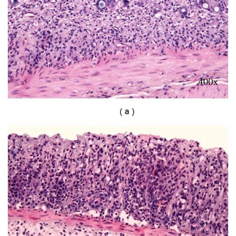 A Vacuolar Hydropic Degeneration Of Cells B Epithelial Necrosis