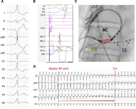 Figure 1 From Bipolar Ablation Of High Risk Posteroseptal Accessory