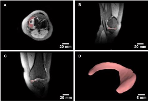 Design Of Patient Specific 3d Digital Model Of The Human Knee Meniscus