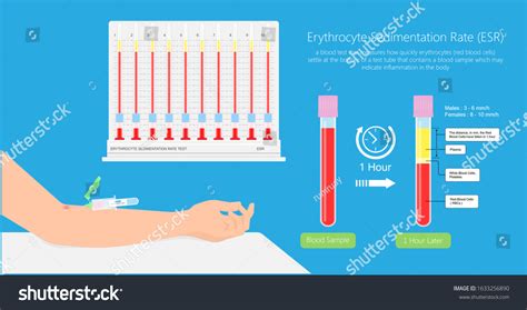 Erythrocyte Sedimentation Rate Test Esr Test Blood Off