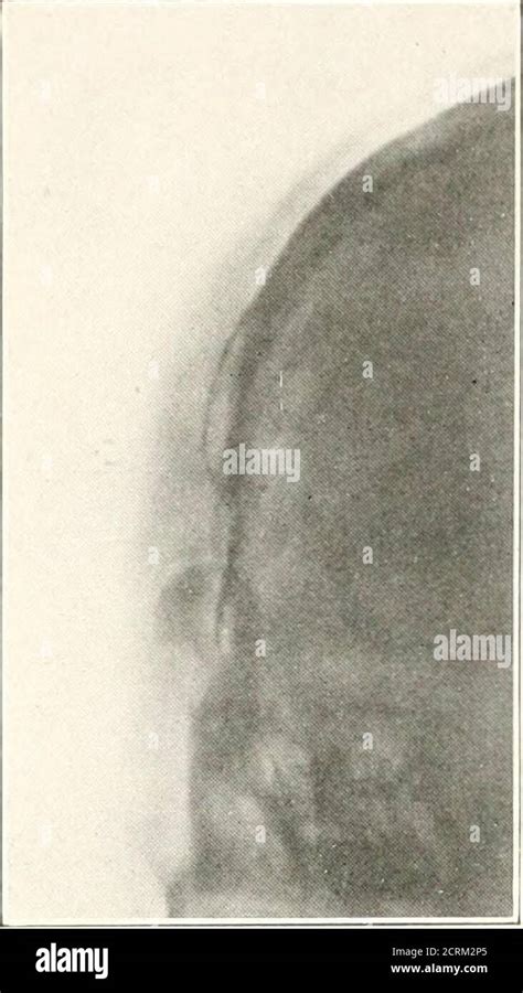 Roentgen Diagnosis Of Diseases Of The Head Mptom Of Local