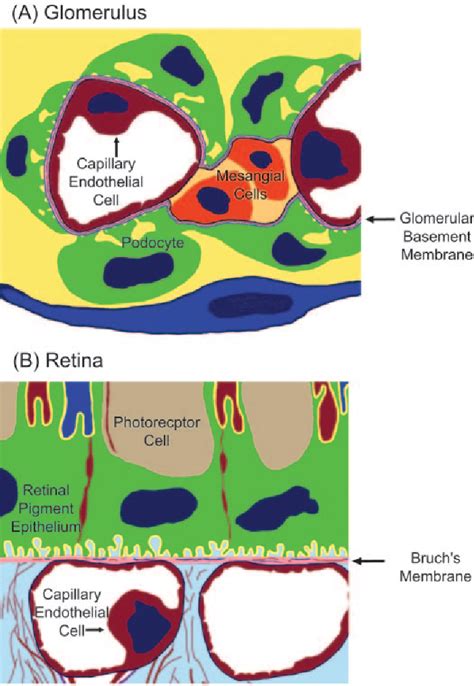 Figure 1 From Membranoproliferative Glomerulonephritis Type Ii Dense Deposit Disease An