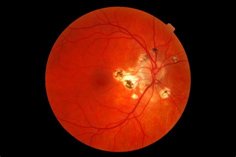 File Presumed Ocular Histoplasmosis Syndrome Png Wikipedia