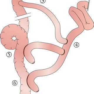 Scheme Depicting Two Side To Side Ileo Colonic Anastomoses Roux En Y