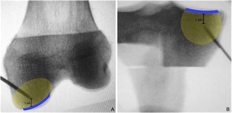 Current Concepts In Intraosseous Platelet Rich Plasma Injections For