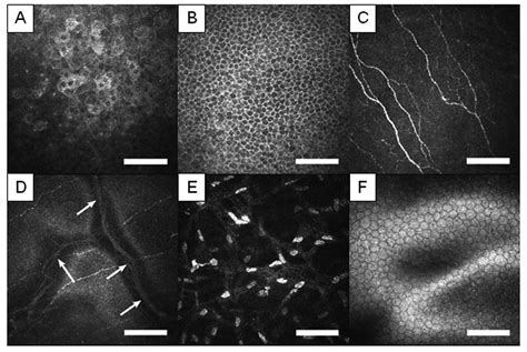 In Vivo Biopsy Of The Human Cornea IntechOpen