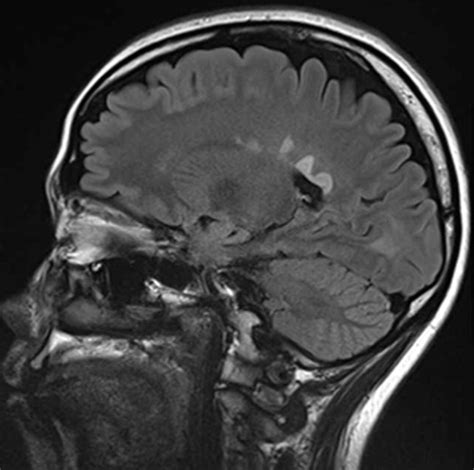 Structure Of The Medullary Veins Of The Cerebral Hemisphere And Related