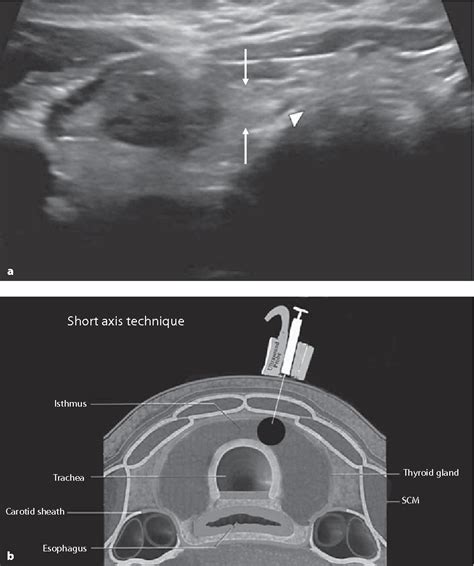 Figure 1 From Comparison Of Ultrasound Guided Biopsy Technique For Thyroid Nodules With Respect