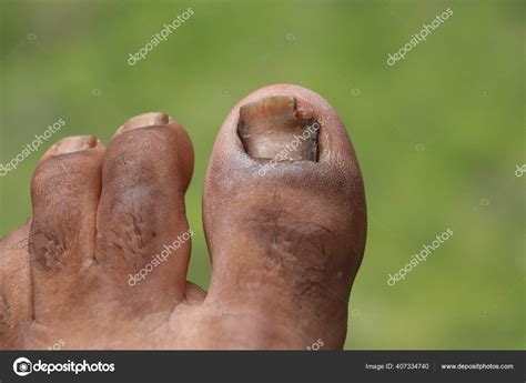 Foot Ulcers Figure Out Nail Toenail Fungus Peak Infection