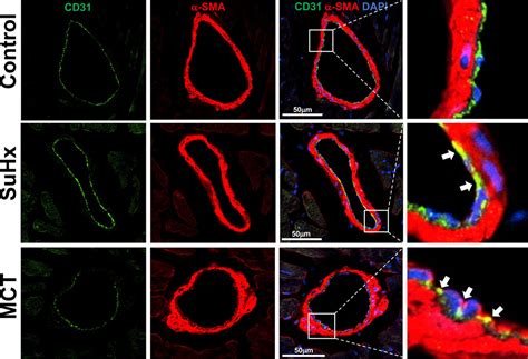 Transcriptomic Analysis Of Right Ventricular Remodeling In Two Rat