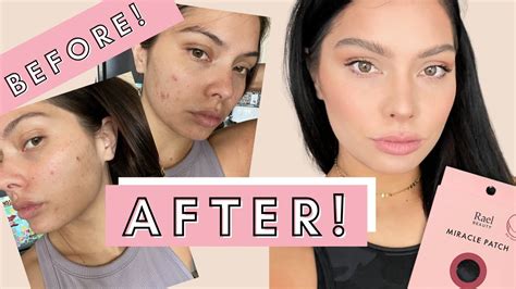 How To Get Rid Of Acne Fast How I Got Clear Skin 2021 How To Get