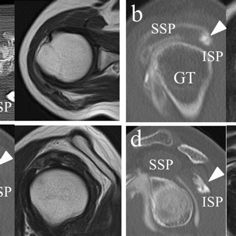 The Infraspinatus Tear Is Visualized By Computed Tomography