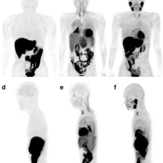 Representative Whole Body Maximum Intensity Projection C Pib Pet