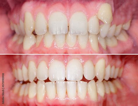 Invisalign Before And After Crooked Teeth