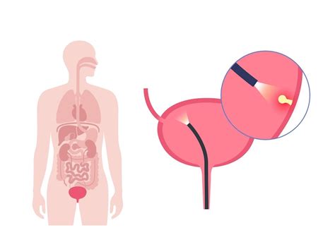 Premium Vector | Cystoscopy is a minimally invasive procedure examination and treatment of the ...