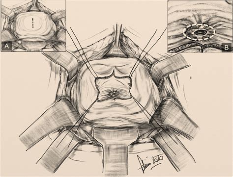 Successful Treatment Of Vesicovaginal Fistulas Via An Abdominal