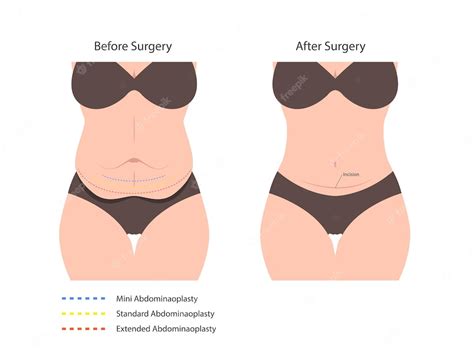 Premium Vector | Abdominoplasty tummy tuck surgery skin fat loss