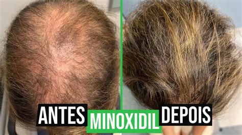 Minoxidil Kirkland 5 3 Meses de Tratamento Capili Cosméticos