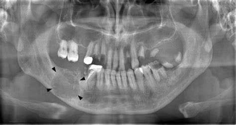 A Panoramic Image Showing A Well Defined Multilocular Radiolucent