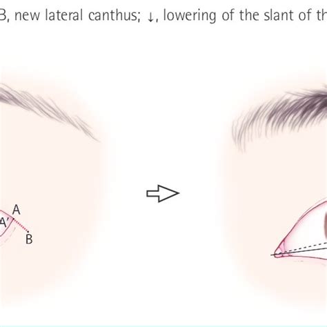 Pdf Cosmetic Lateral Canthoplasty Lateral Canthoplasty To Lengthen