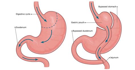 Bariatric Patient Blooming After Gastric Bypass Surgery Bailey Bariatrics