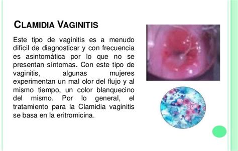 Infecciones Vaginales