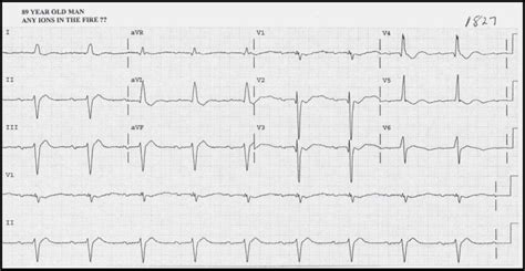 Hypokalemia Hyperkalemia Ecg