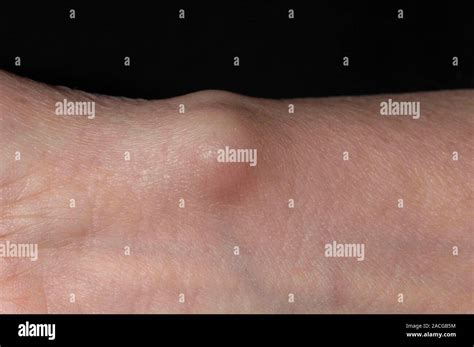 close    ganglion   wrist    year  female patient