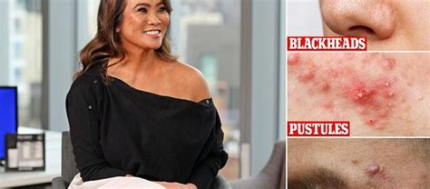 Dr Pimple Popper Reveals Everything About Zits Cysts And Blackheads