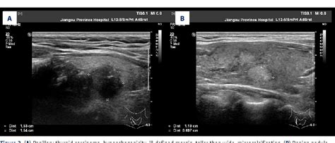 Figure 1 From A Predictive Model To Distinguish Papillary Thyroid